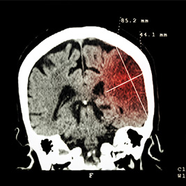 Cerebrovasculair accident 